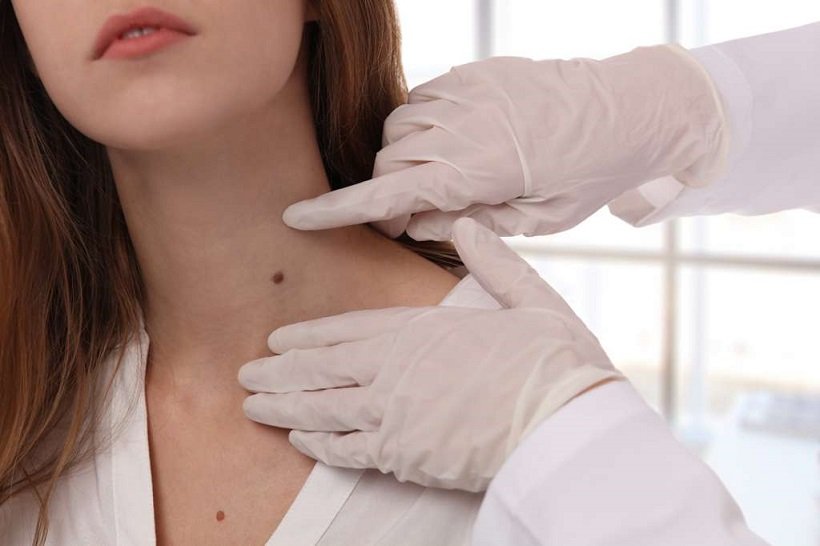 Mole Removal In Dubai: Step-By-Step Procedure